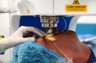 Laser Vision Surgery