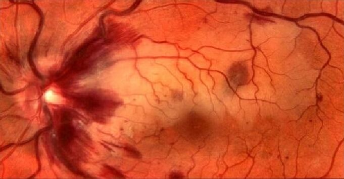 retinal blood vessels and vision restoration