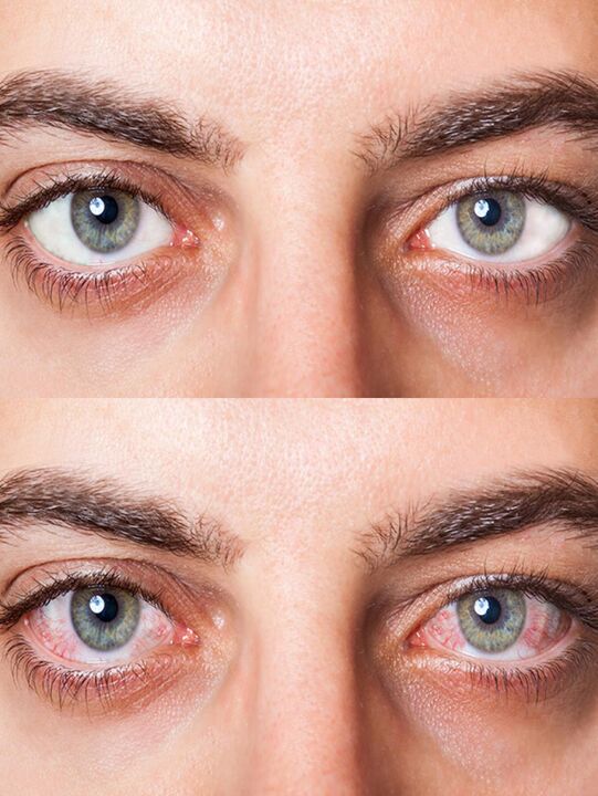 before and after treatment with Oculear drops